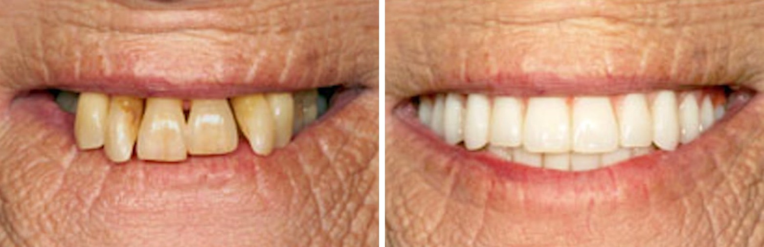 Before and after dental implant treatment at Forte Implant Center
