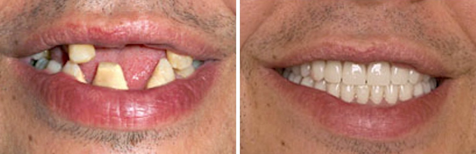 Before and after dental implant treatment at Forte Implant Center