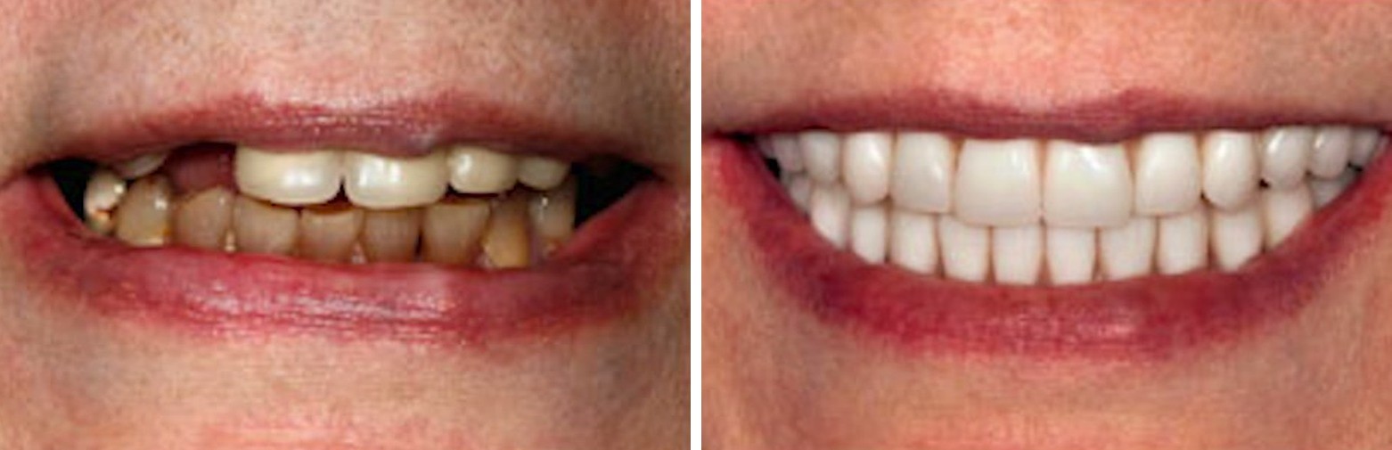 Before and after dental implant treatment at Forte Implant Center