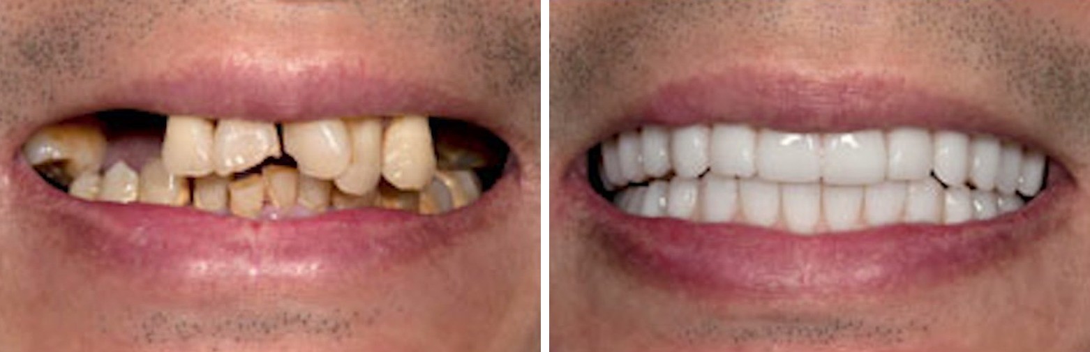 Before and after dental implant treatment at Forte Implant Center