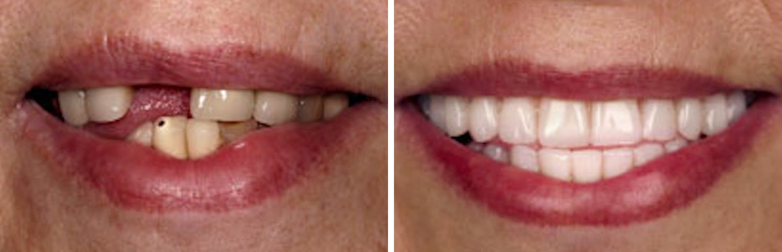 Before and after dental implant treatment at Forte Implant Center