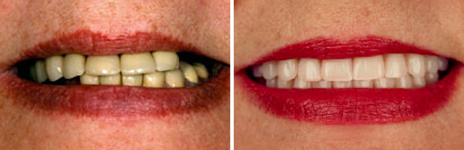 Before and after dental implant treatment at Forte Implant Center